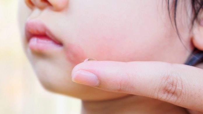 'Slapped cheek' virus spreads in US: Know its symptoms and who is at risk